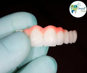Home Care & Cleaning Guide for Your Implant-Supported Overdenture