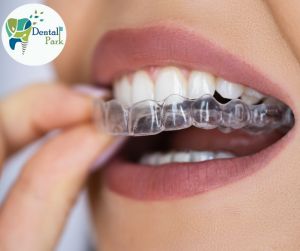 Dental aligners in Ghaziabad at Dental Park Ghaziabad, the best clinic for treating crowded teeth, offering superior orthodontic treatment over Clove Dental and Toothsi