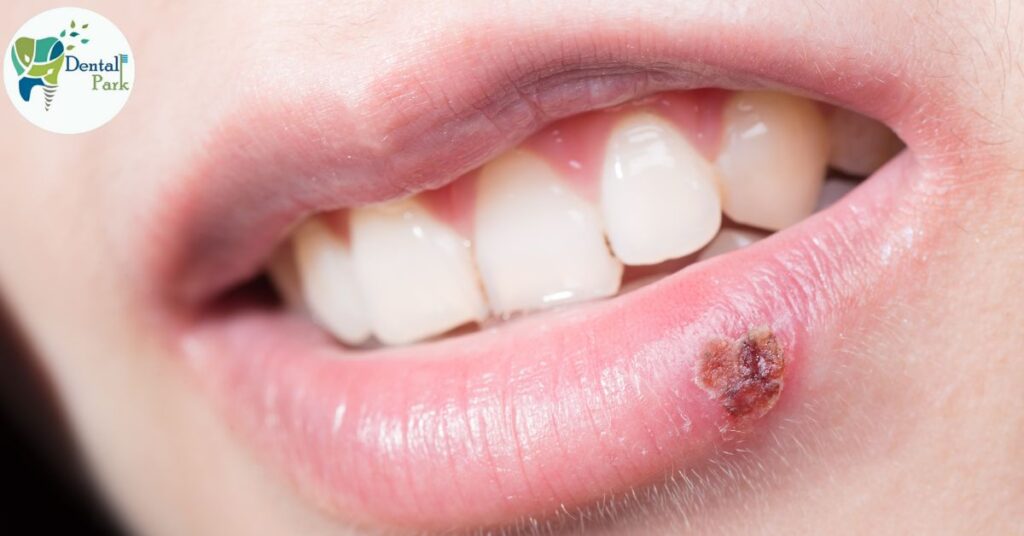 Lip Ulcer After Fever