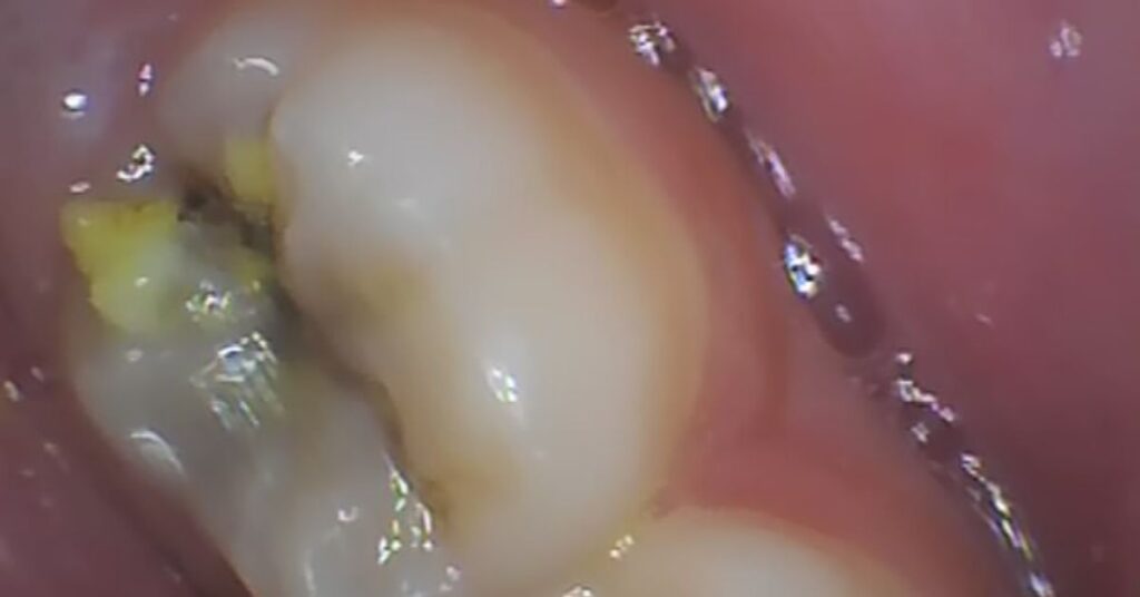 best-dental-cavity-treatment-dentist-in-shastri-nagar-ghaziabad