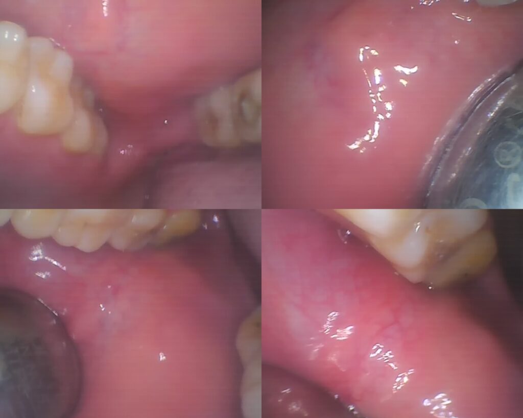 Clinical view of Stensen's duct opening in the buccal mucosa - Dental Park